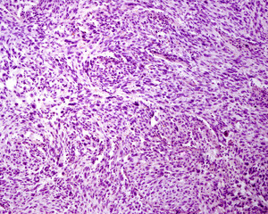 Melanoma. Human lymph node metastasis