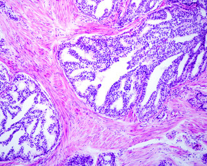 Human prostate. Cribriform cancer
