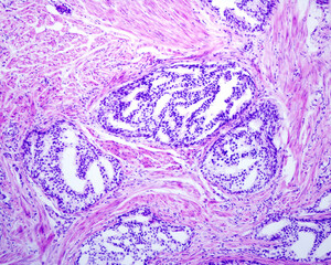 Human prostate. Cribriform cancer