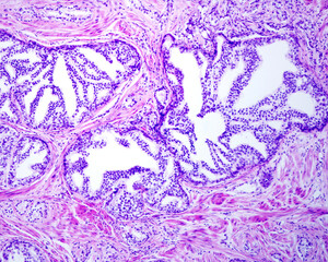 Human prostate. Cribriform cancer