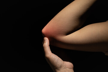 Close-up of a person holding an inflamed elbow with red irritation, illustrating joint pain, injury, inflammation, medical issues, or physical discomfort on a dark background