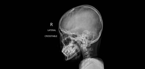 Skull x-ray showing cranial bones and facial skeleton. Lateral crosstable radiograph for diagnostic examination of head anatomy and skeletal structure © Issara