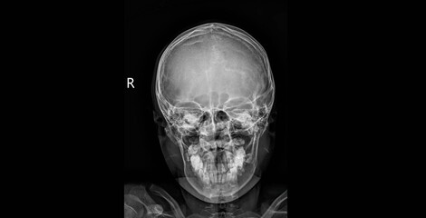 
Skull x-ray showing cranial bones, facial skeleton and teeth. AP radiograph for diagnostic examination of head anatomy and skeletal structure