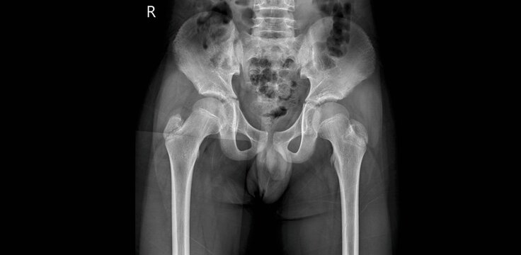 Pediatric pelvic x-ray showing hip joints and femurs. AP radiograph for diagnostic examination of pelvis and bilateral hip anatomy in children
