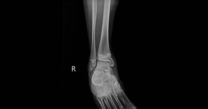 Ankle and lower leg x-ray showing tibia, fibula and ankle joint. Lateral view radiograph for diagnostic examination of ankle anatomy and bone structure