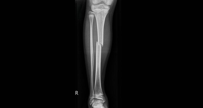 Tibia fracture x-ray showing broken bone with displacement. AP and lateral view radiographs for diagnostic examination of tibial shaft fracture and trauma injury