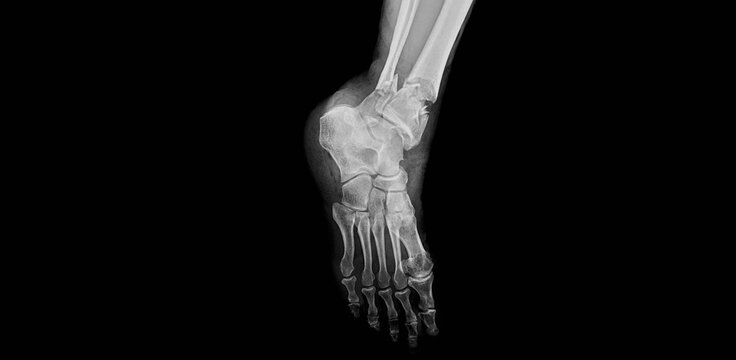 Ankle and lower leg x-ray showing tibia, fibula and ankle joint. Lateral view radiograph for diagnostic examination of ankle anatomy and bone structure