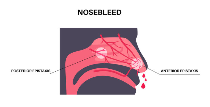 Nosebleed medical poster