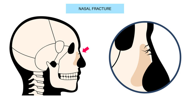 Nasal fracture poster
