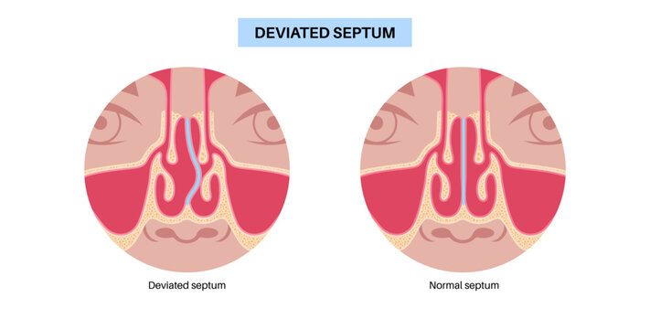 Deviated septum poster