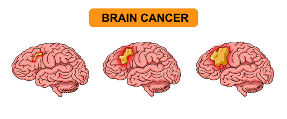  Brain tumor illustration. Human brain cancer, glioma, tumor in human brain tissue. Cancer cell structure. Vector illustration for medical, scientific, and educational purposes.