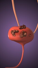 Human Urinary System with Cancer Infection