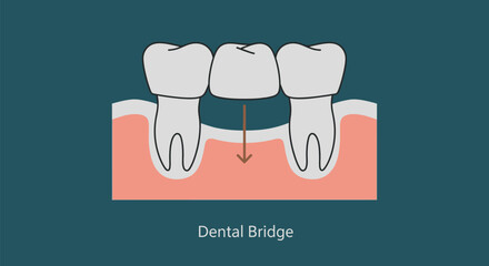 Dental bridge diagram showing tooth replacement and gum health