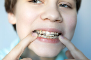 Teen smiles while showing off braces and adjusted dental appliance in a well-lit room during daytime