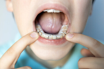 Young person demonstrating an orthodontic appliance in their mouth for dental care and alignment during an oral health check-up