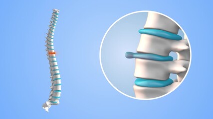 Chronic Back Pain Due to Spinal Disc Bulge