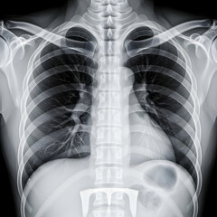 Examining Chest X-ray for Diagnostic Purposes in Medical Field