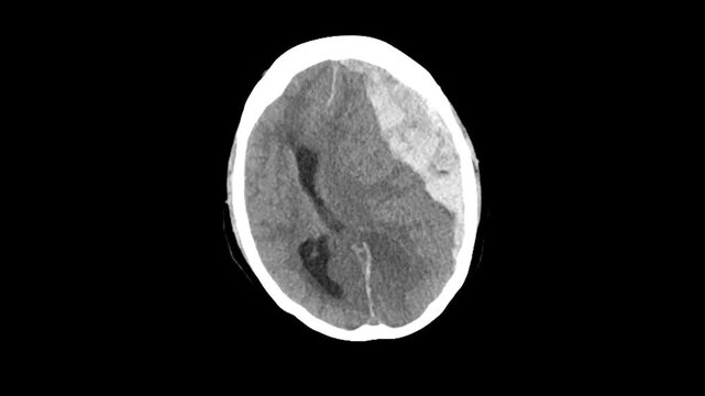 Acute Subdural Hemorrhage with Midline Shift and Herniation on Brain CT