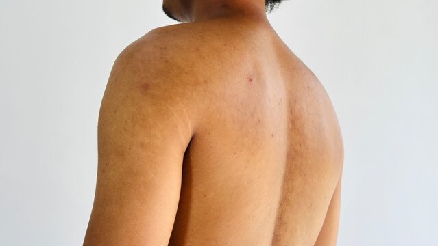 Human back with visible skin marks and hyperpigmentation