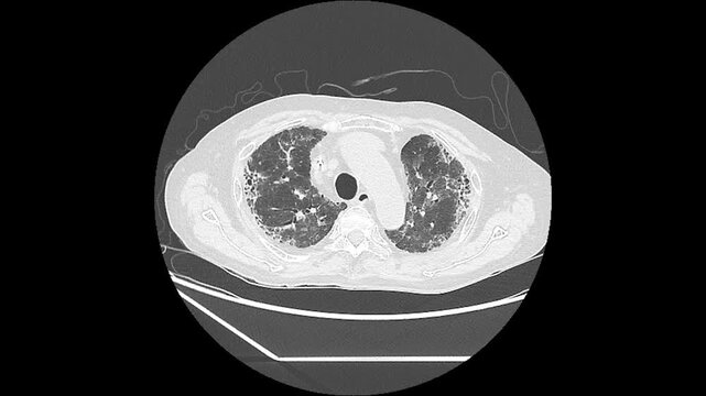 CT Chest Showing Interstitial Lung Disease with Fibrotic NSIP Pattern and Bilateral Ground-Glass Opacities