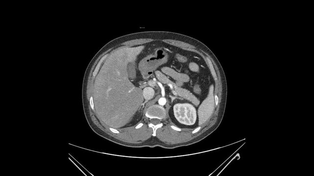 Abdominal CT Showing Multiple Small Liver Abscesses in Segments S4a, S7, and S8