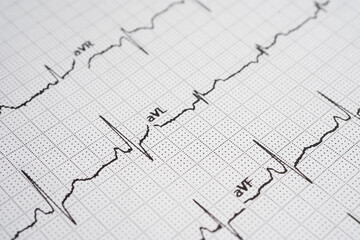 Electrocardiogram (ECG), heart wave, heart attack, cardiogram report.