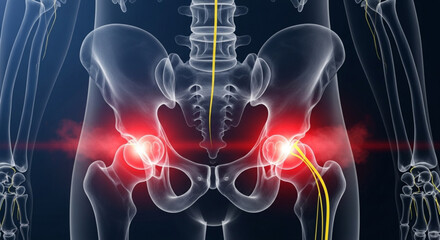 Anatomical illustration of the human pelvis with nerve pathways and areas of highlighted pain shown