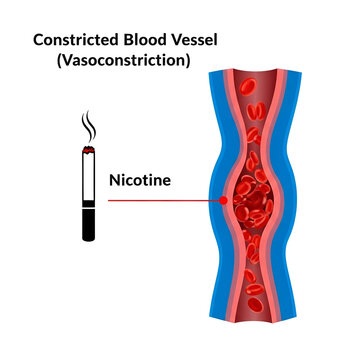 Nicotine caused vasoconstriction in blood vessel illustration, smoking disadvantages and health risks concept