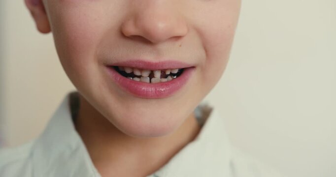 Close-up of a boy mouth smiling, with decayed front baby teeth and healthy new permanent lower teeth
