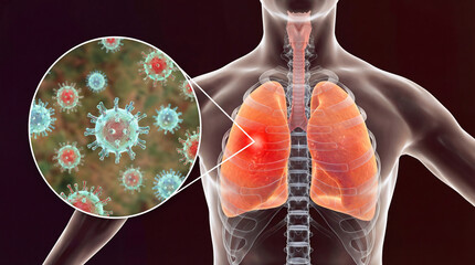 Human lungs with viral infection illustration of pneumonia or COVID-19 medical visualization