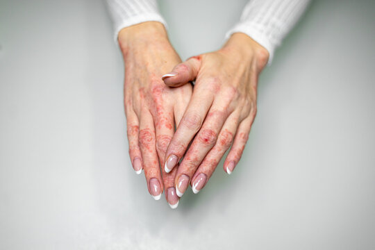 Hands showing symptoms of eczema, contact dermatitis, and psoriasis from different skin conditions on a light gray surface - Powered by Adobe