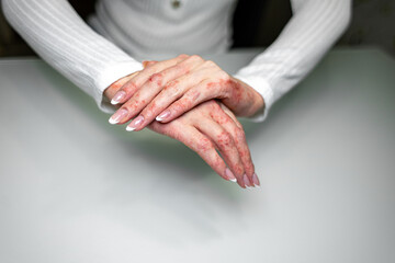 Skin conditions such as eczema and psoriasis affect hands of individual during treatment at a clinic