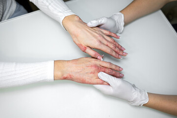 Treatment of eczema and psoriasis on hands with medical professional assisting in dermatology clinic
