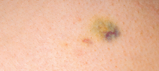 Fototapeta premium Close-up of a multicolored bruise on human skin, showing injury detail, texture, and healing process, suitable for medical, health, and safety themes.