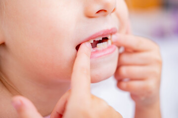 smiling child's mouth showing gap from missing milk teeth, baby teeth, growth and development, visit Tooth Fairy, joyful expression, childhood development, front teeth losing, innocence and transition
