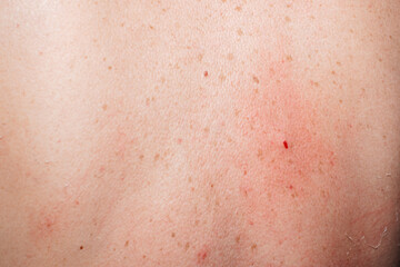 Fototapeta premium Close-up of human skin with a fresh drop of blood, showing natural texture, pores, freckles, and realistic epidermis detail.