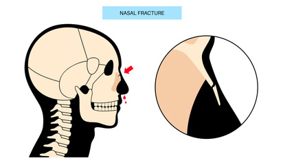 Nasal fracture poster