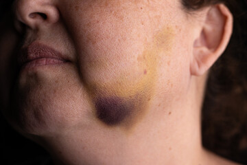 Obraz premium Close-up of a woman’s face with a bruise on the cheek – injury, healing process, and skin discoloration.