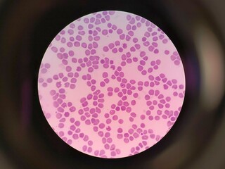 Plasmodium ovale (Malaria ovale) Parasites within Blood Cells (Erythrocytes) Under a Microscope. 
