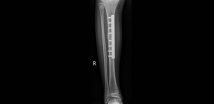 Postoperative tibia x-ray showing fracture fixation with plate and screws. AP and lateral view radiographs after ORIF surgery for tibial shaft fracture treatment
