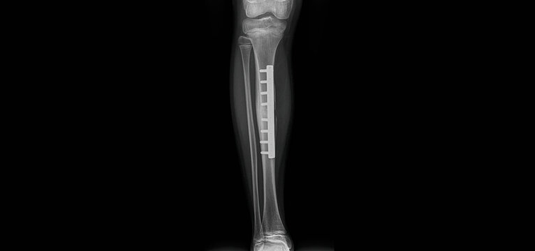 Postoperative tibia x-ray showing fracture fixation with plate and screws. AP and lateral view radiographs after ORIF surgery for tibial shaft fracture treatment
