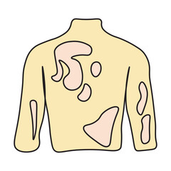Tinea Versicolor on Human Back Skin
