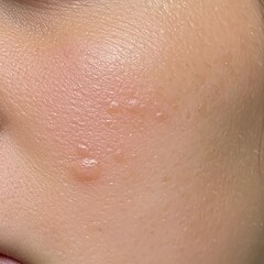 Fototapeta premium Close up of human skin displaying several small raised bumps and texture