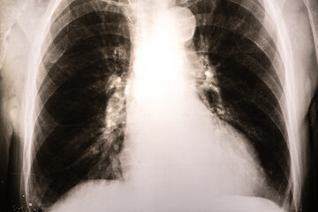 X-ray picture with pneumonia, fluorography. Diagnostics of human lung and respiratory tract diseases.
