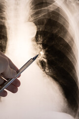 Doctor learn vertical X-ray picture with pneumonia, fluorography. Diagnostics of human lung and respiratory tract diseases.