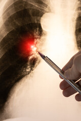 Doctor learn vertical X-ray picture with pneumonia, fluorography. Diagnostics of human lung and respiratory tract diseases.