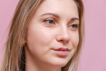 Obraz premium Closeup on herpes cold sore on mouth of young woman with pink background. Herpes blisters