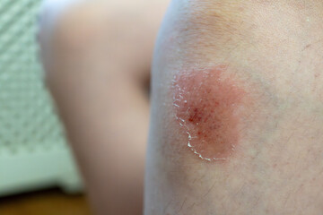 Fototapeta premium Skin rash on caucasian boy with dry texture and redness