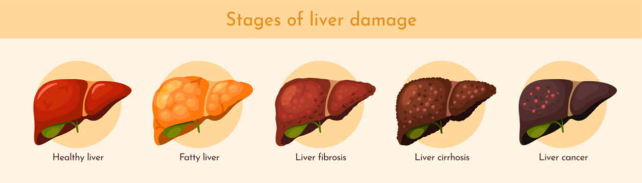 Stages of liver destruction. Medical infographic showing process of liver cell damage leading to fibrosis, cirrhosis, and cancer. Pathological process. Flat vector illustration