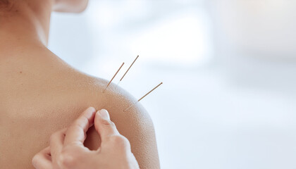 Acupuncture needles inserted into a person's shoulder for alternative medicine treatment and pain relief.